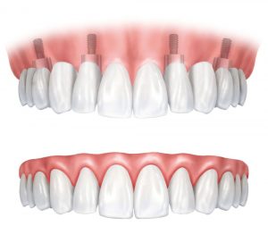 An illustration of a traditional denture and an implant-supported denture