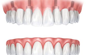 An illustration of a traditional denture and an implant-supported denture