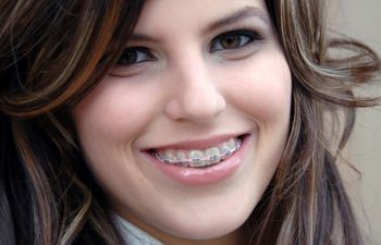 A teen with healthy teeth and braces