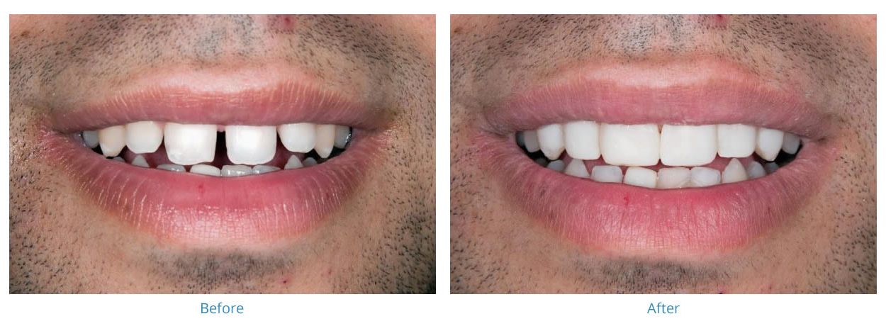 Porcelain Veneers - Before and After Gallery