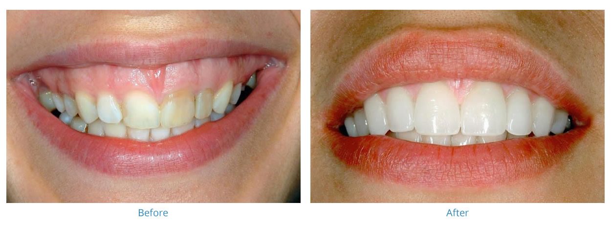 Porcelain Veneers 2 - Before and After Gallery