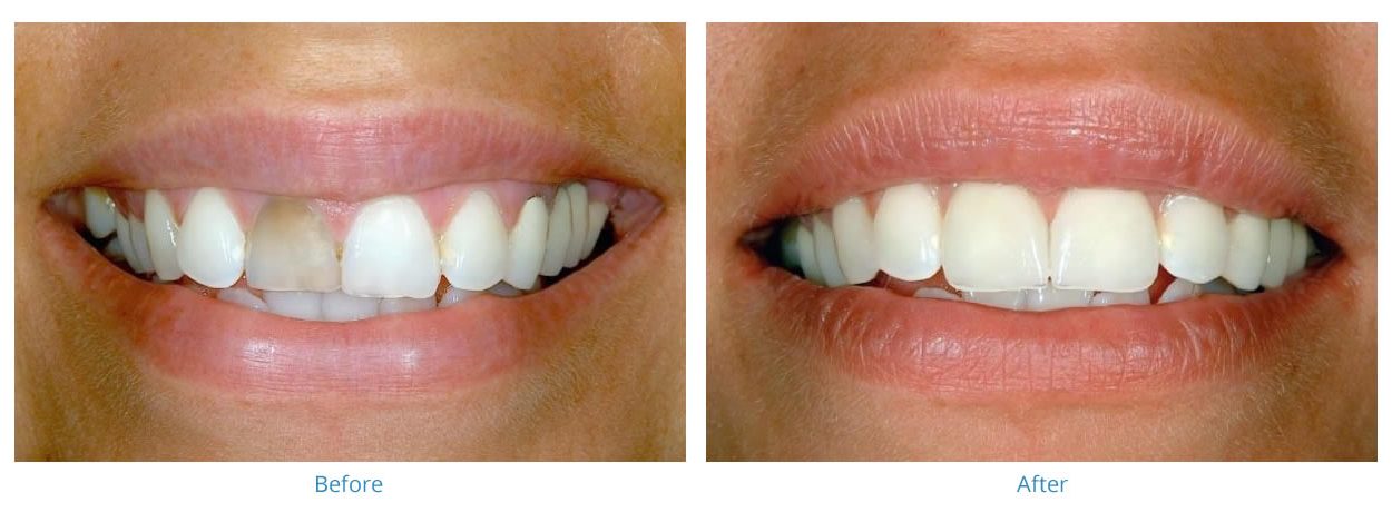 Porcelain Veneers - Before and After Gallery