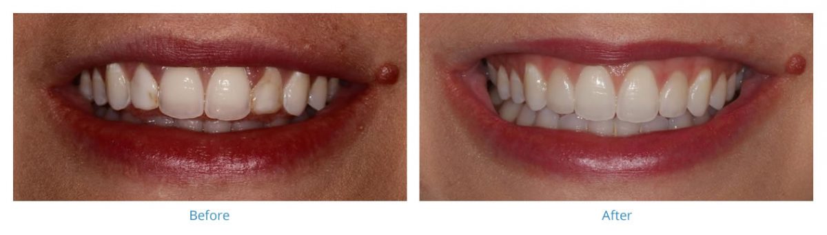 Porcelain Veneers - Before and After Gallery