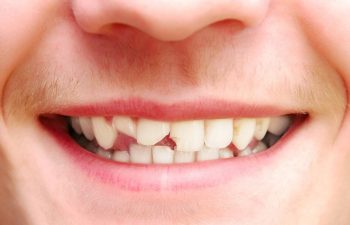 A close-up of a young man's chipped front teeth