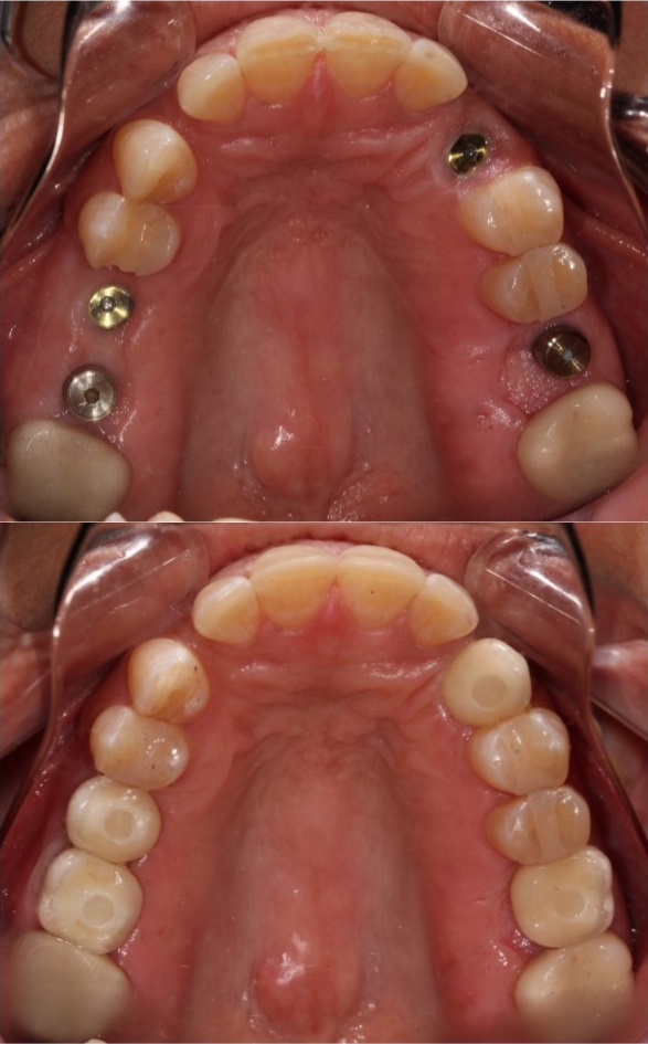 Dental implants - before and after photos