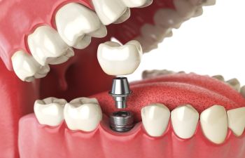 Single Dental Implant Atlanta GA